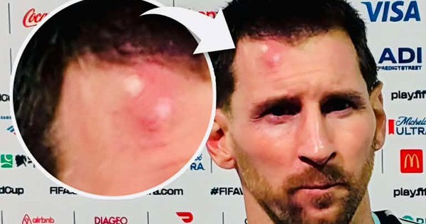 Messi sưng vêu trán sau trận thắng Cabo Verde: Vì sao nên nỗi? - hình ảnh - betau88.vip